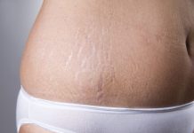 Jeg vil gerne høre om det er godt at bruge aloe vera gel på maven for at "undgå" strækmærker?