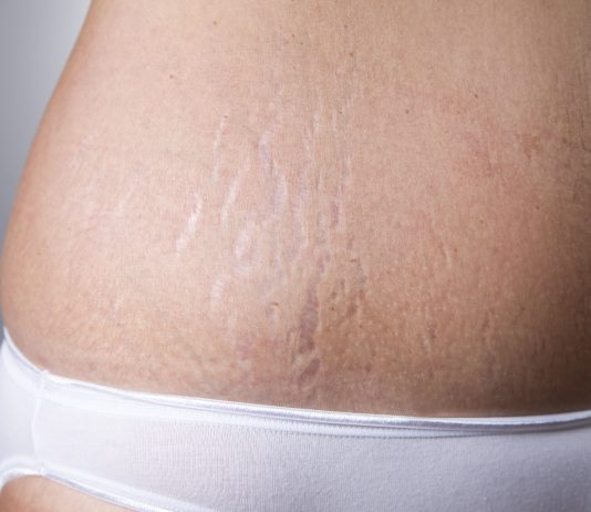 Kan jeg bruge aloe vera gel på maven for at “undgå” strækmærker? Jeg vil gerne høre om det er godt at bruge aloe vera gel på maven for at "undgå" strækmærker?